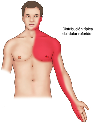 Molestias cardiacas, la angina