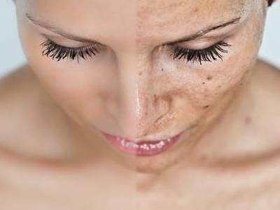 Cloasma o melasma.