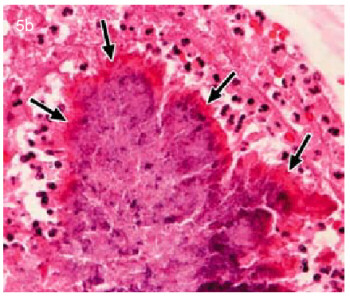 Actinomicosis, una enfermedad bucal