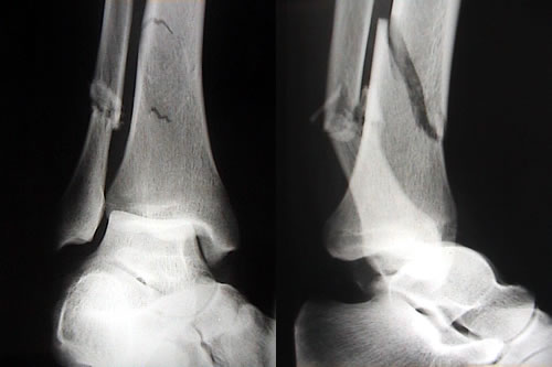 Investigadores Argentinos comprueban que la enfermedad celíaca aumenta el riesgo de fracturas