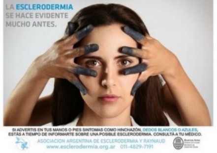 Esclerodermia: un misterio que aún no se devela