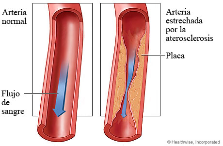 El cuidado de las arterias.