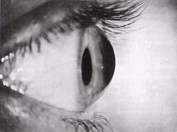 Premian un avance Argentino que logra frenar un trastorno ocular, el queratocono