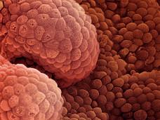 Hallan un gen que revela riesgo de cáncer de próstata