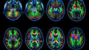 La adicción a internet cambia el cerebro