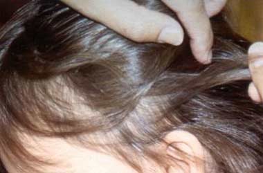 Investigadores Argentinos desarrollan nueva herramienta para eliminar piojos y liendres