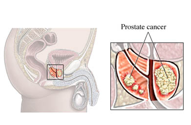 Cáncer de próstata.