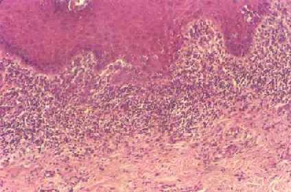 ¿Que es el Liquen Plano?