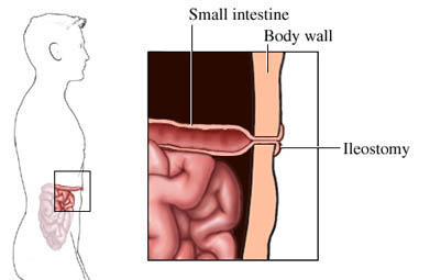 Una cirugía pionera en el mundo