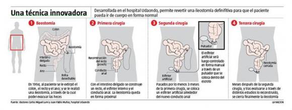 Médicos Argentinos desarrollan una cirugía pionera en el mundo