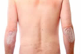 Si padece de psoriasis, puede también padecer de artritis psoriásica.