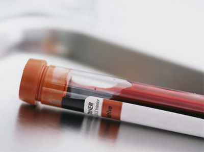 El examen sanguíneo materno podría ayudar a detectar problemas fetales