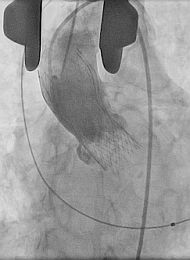 Medicos Argentinos realizan novedosa cirugía para reemplazar válvula cardíaca‏