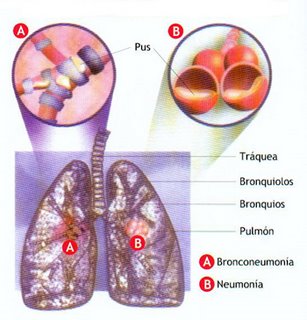 Neumonía, sus síntomas.