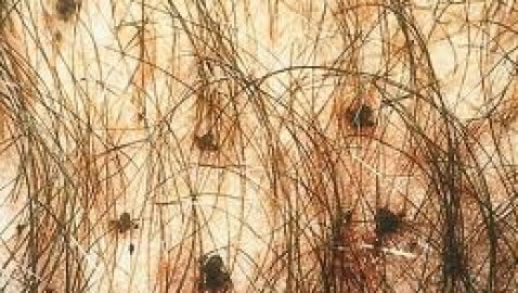 ¿Qué es el Pthirus Pubis?