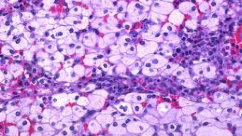 Alteraciones congénitas del catabolismo de lípidos complejos