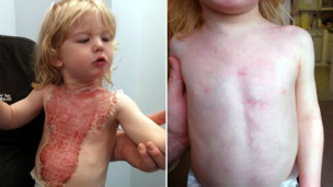 El aerosol que cura quemaduras