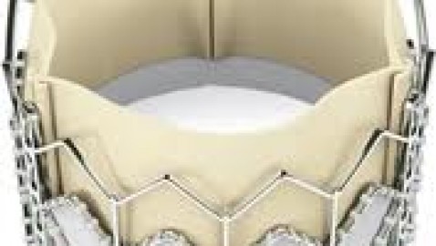 Válvula aórtica artificial que no necesita cirugía a corazón abierto.