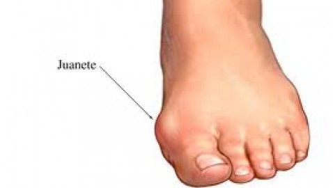 Remedio para los molestos juanetes