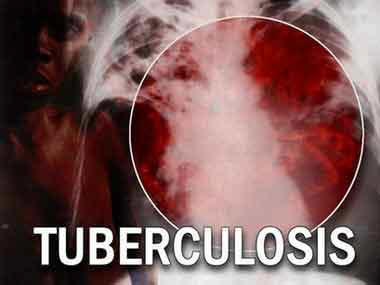 Tuberculosis, sus síntomas.