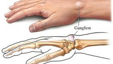 Quistes sinoviales en las manos.