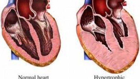 Posible gen responsable de cardiomiopatía.