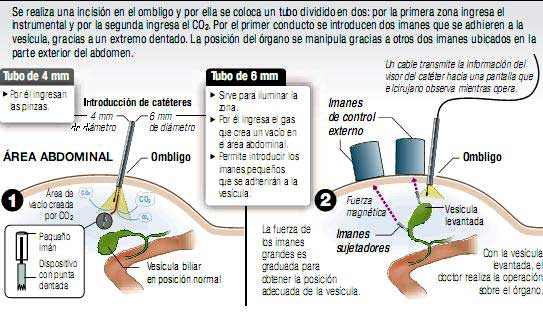 Médico Argentino inventó una novedosa cirugía con imanes mínimamente invasiva