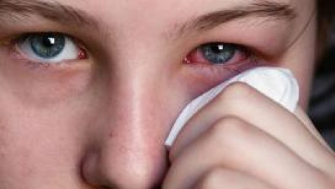 Aceite de Girasol para la Conjuntivitis.