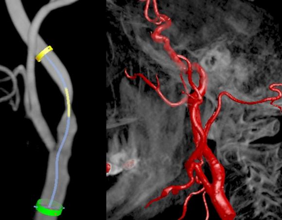 Pequeños infartos cerebrales asociados a un mayor riesgo de muerte.