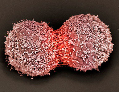 El uso prolongado de hormonas incrementa el riesgo de cáncer.