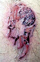 ¿Cuáles son los riesgos de hacerse un tatuaje?