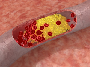 El mapa mundial del colesterol
