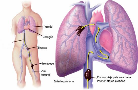 Enfermedades autoinmunes parecen aumentar el riesgo de embolias pulmonares