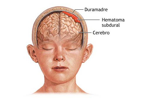 Ictus: Síntomas y tratamiento
