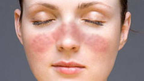 Nueva droga para el tratamiento de lupus erimatoso