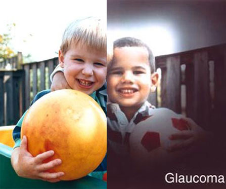 Expertos reportan que la actividad física podría prevenir el glaucoma