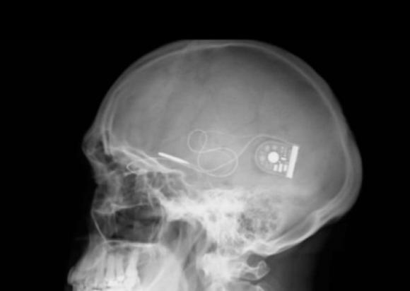 Implantan chip que devuelve parcialmente la vista