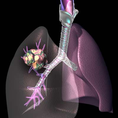 El estigma y la vergüenza pueden empeorar los síntomas depresivos en pacientes con cáncer de pulmón