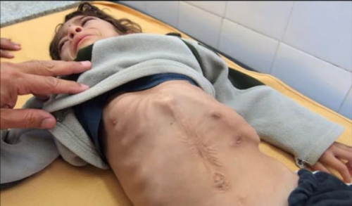 La lucha desigual de un niño que se muere por desnutrición.