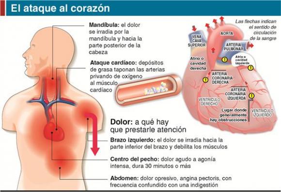 Médico Argentino crea una tabla más precisa para medir el riesgo de infarto