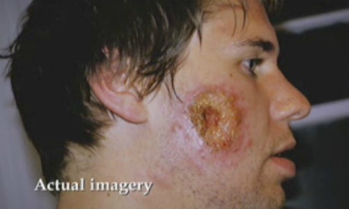 Pesadilla de un turista picado por un mosquito en América del Sur