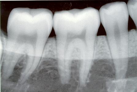 Radiografías dentales se relacionan a meningiomas