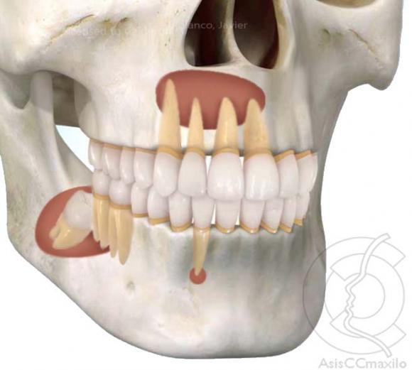 Tumores y quistes maxilares: anuncian novedosa guía de diagnóstico y pronóstico