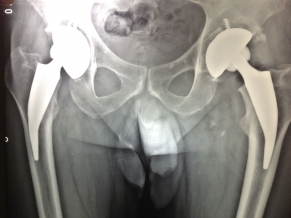 Medicos Argentinos presentan una revolucionaria técnica para tratar la artrosis de cadera