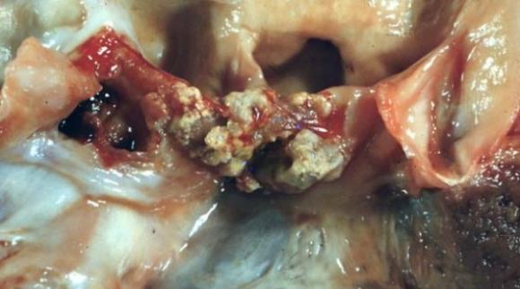 Científicos Argentinos de la UBA desarrollan un método para identificar las causas de una infección del corazón‏