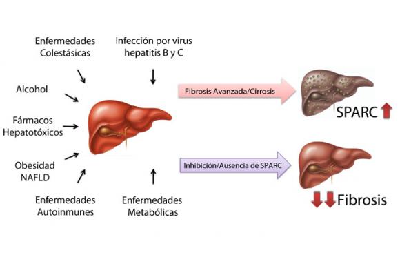 Científicos Argentinos investigan un tratamiento prometedor para la cirrosis hepática