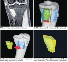 Ingenieros y Medicos Argentinos revolucionan las cirugías de cáncer óseo con realidad virtual