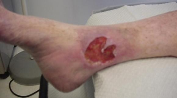 Científicos Argentinos regeneran los agujeros de la piel