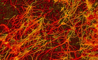 Cientificos Argentinos y de EE.UU. detectan el mecanismo clave de la esclerosis lateral amiotrófica