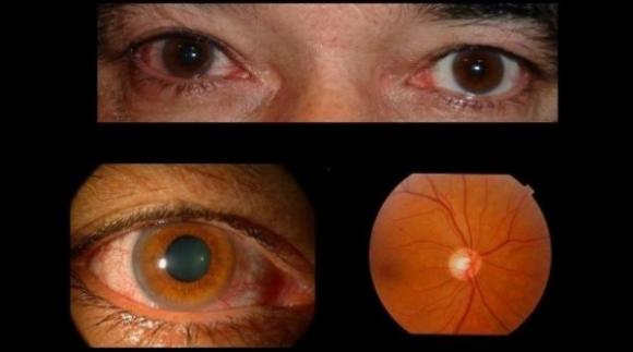 Investigadores argentinos descubrieron que la modificación del entorno puede mejorar algunas lesiones oculares